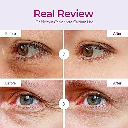 Before and After using Dr.Melaxin Cemenrete Calcium Volume Eye Patch
